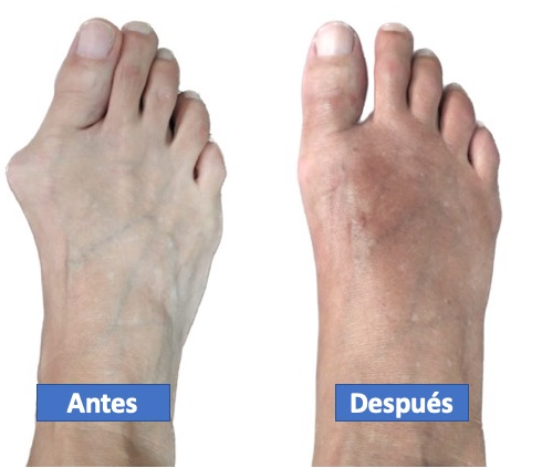 Cirugía Hallux Valgus o Juanete